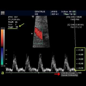 heart doppler test results mild